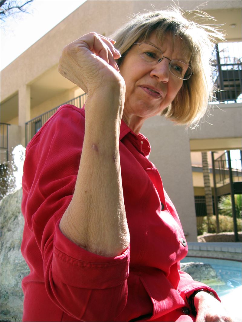 Tattoo removal geelong area, tattoo removal excision before and after time