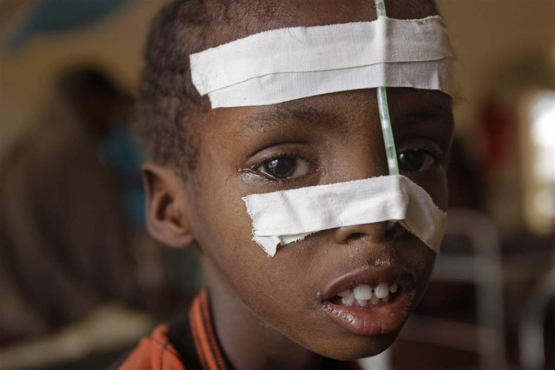 Kenya-feeding-tube-taped-face