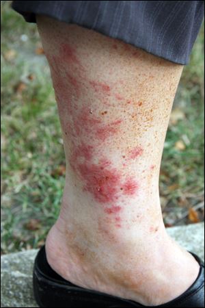 Poison ivy can leave sufferers with rashes such as this.