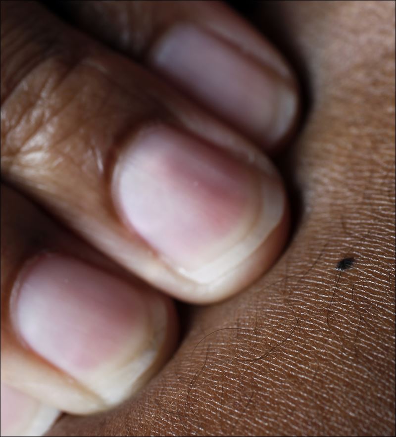Collection 101+ Images pictures of skin cancer in african american Sharp
