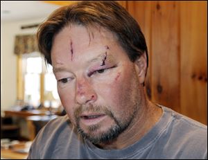 Roger Mundell Jr., bears cuts on his face at his home in Brookfield, Mass., Monday, after being attacked by a bobcat in his garage Sunday. 