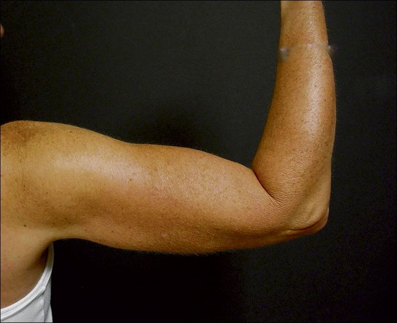 Going under the knife to fix flabby arms Toledo Blade