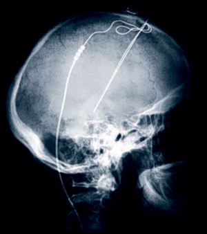This image shows the X-Ray image of a patient with Deep Brain Stimulation leads implanted. Deep brain stimulation is routinely done for Parkinson's disease and some other illnesses, such as epilepsy.