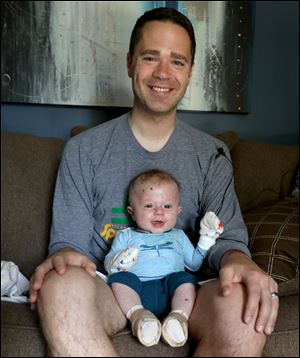 Kirk Brazeau with his infant Archer Brazeau, his three-month-old who was born with a rare skin condition called Epidermolysis Bullosa. 