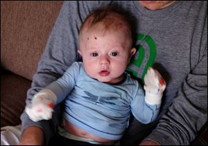 Archer Brazeau, a three-month-old who was born with a rare skin condition called Epidermolysis Bullosa. 