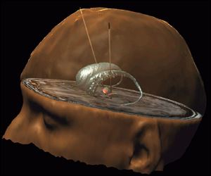 An illustration from doctors in France depicts two electrodes inserted into a part of the brain that deals with motion, thinking, and emotion. In a study of 16 patients with obsessive-compulsive disorder, symptoms nearly disappeared for four of them. Serious side effects were reported in several of the patients.