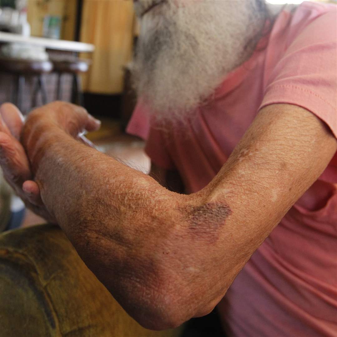 Dallas-Watts-body-is-bruised-and-sore