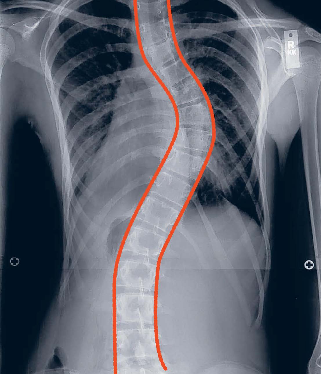 Ahead of the curve Surgery for scoliosis no longer so devastating for