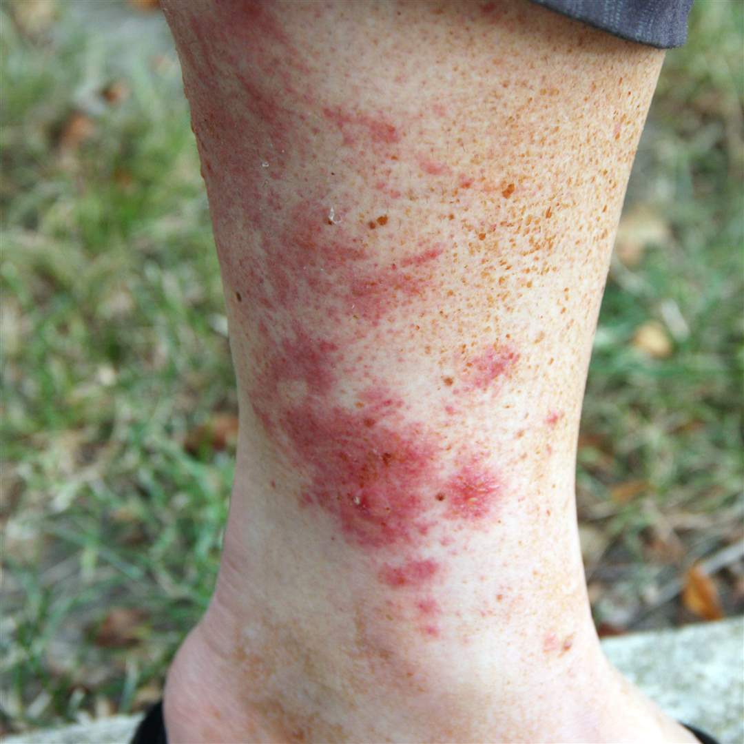 Pictures Poison Ivy Rash Early Stages At Bridget Huizenga Blog Pictures Poison Ivy Rash Early Stages At Bridget Huizenga Blog