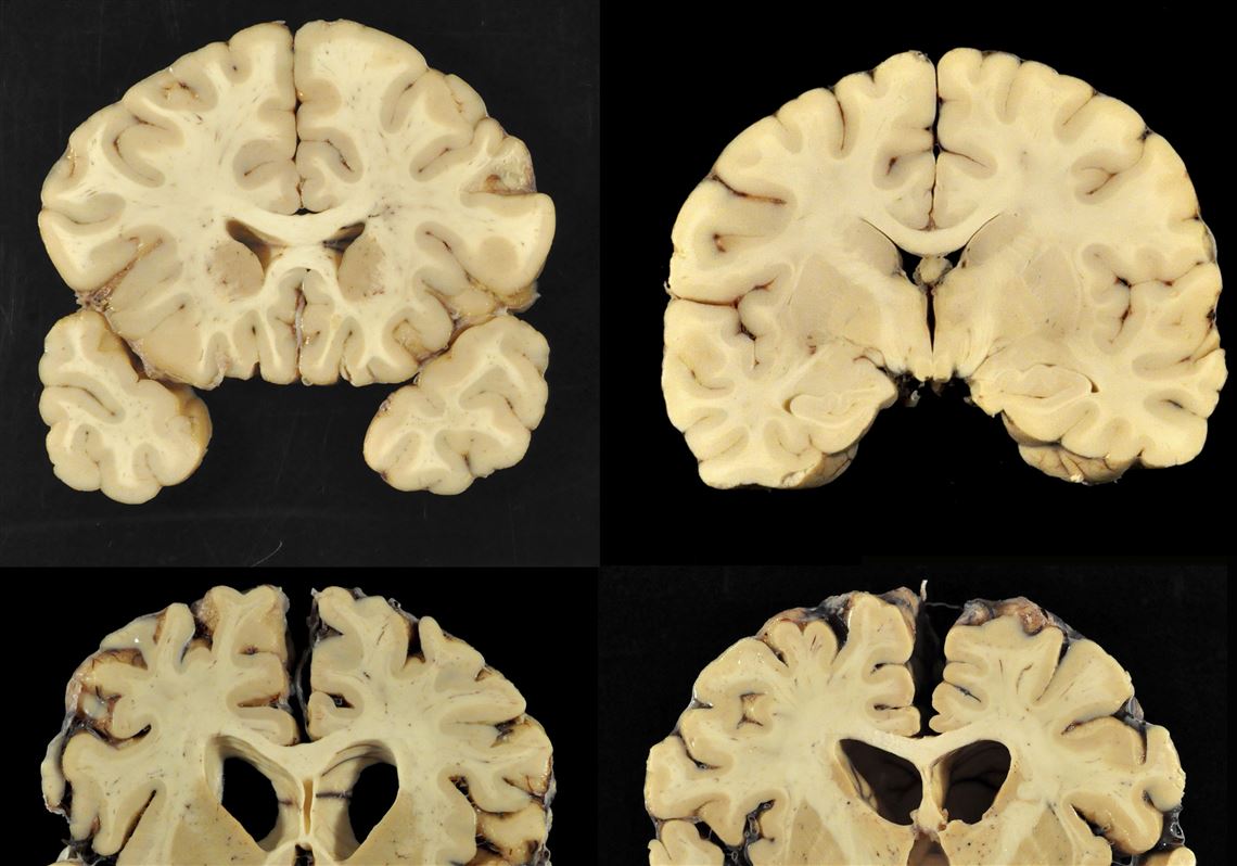 This combination of photos provided by Boston University shows sections from a normal brain, top, and from the brain of former University of Texas football player Greg Ploetz, bottom, in stage IV of chronic traumatic encephalopathy.