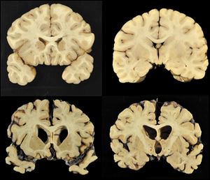 This combination of photos provided by Boston University shows sections from a normal brain, top, and from the brain of former University of Texas football player Greg Ploetz, bottom, in stage IV of chronic traumatic encephalopathy.
