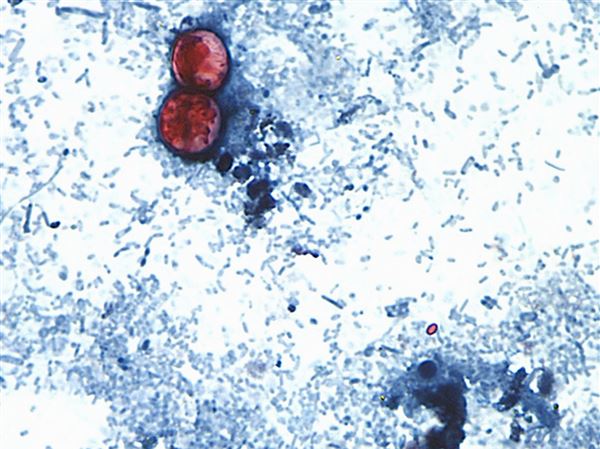 Nearly 500 cyclosporiasis new cases in northwest Ohio this week